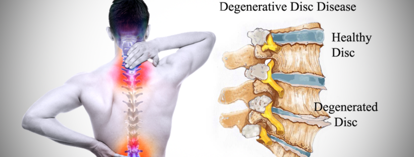 Degenerative disc disease infographic