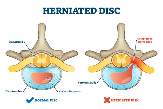 Disc herniation infographic
